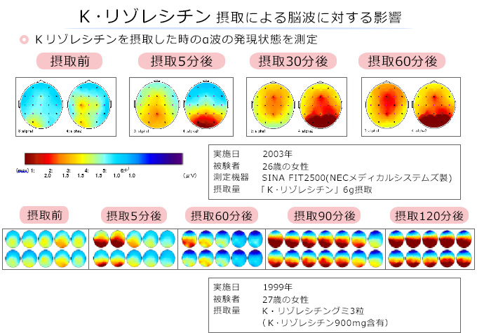 脳波の臨床試験